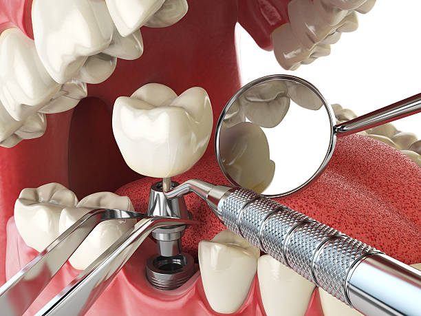 Best Lost Filling or Crown Replacement in Lihue, HI